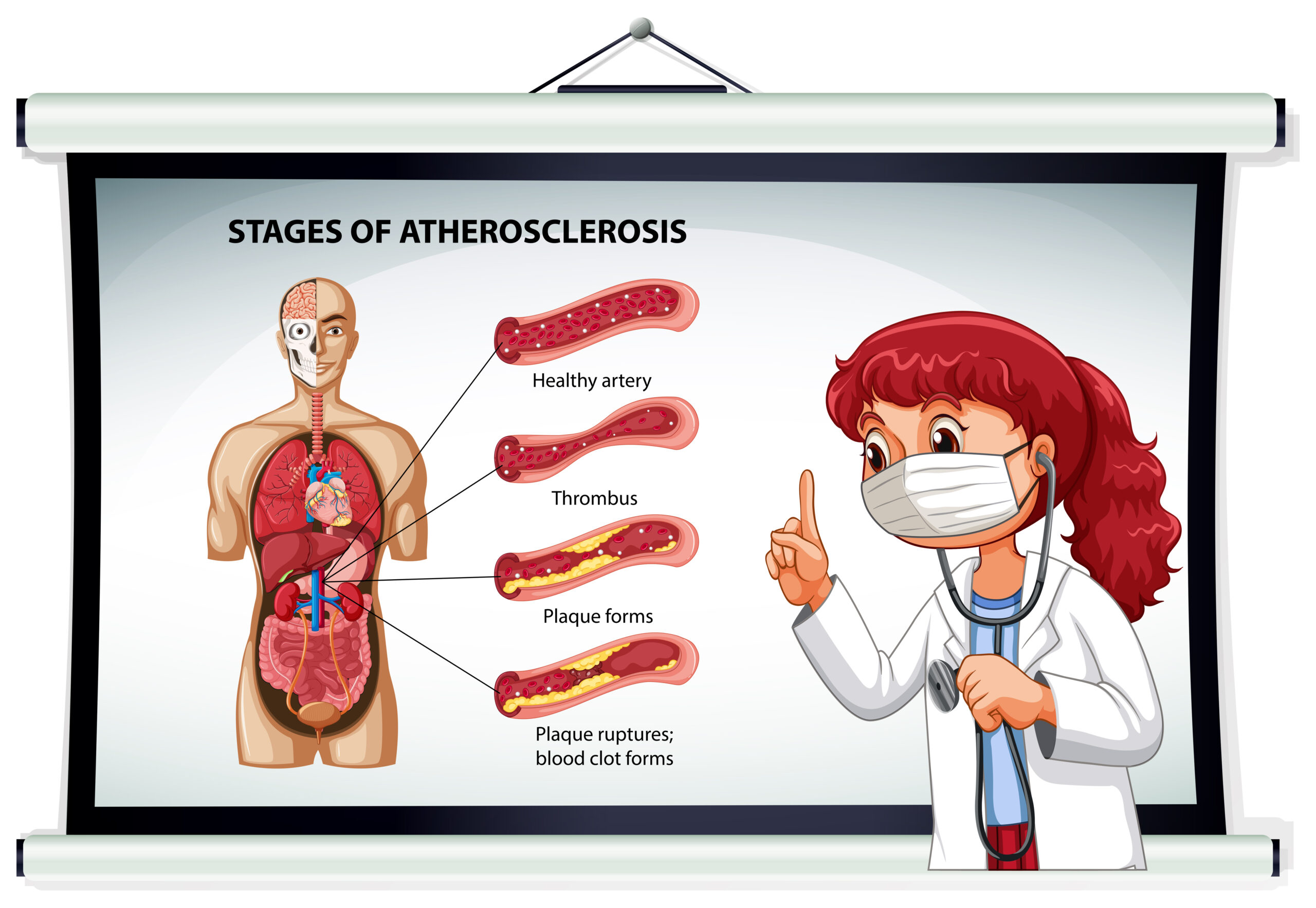 Carotid Artery Stenosis Ultrasound Diagnosis