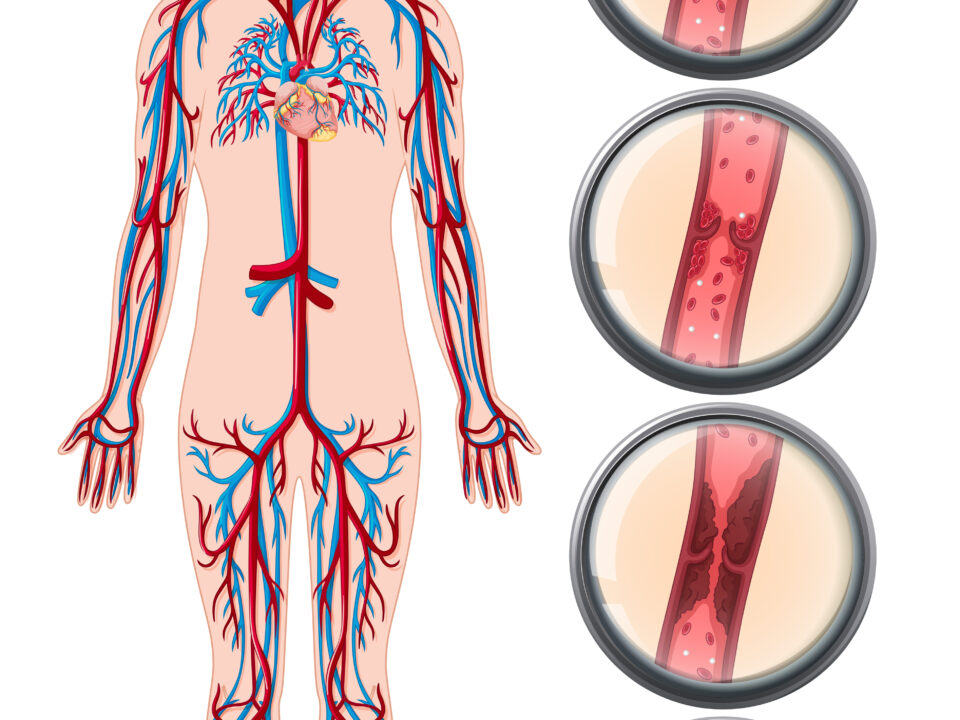 DVT Deep Venous Thrombosis