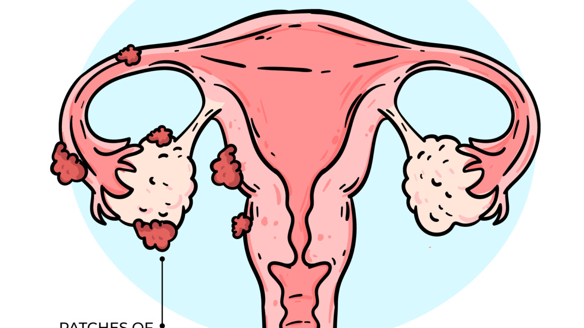 Deep Infiltrating Endometriosis (DIE)