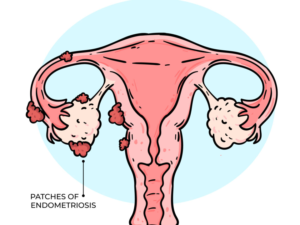Deep Infiltrating Endometriosis (DIE)