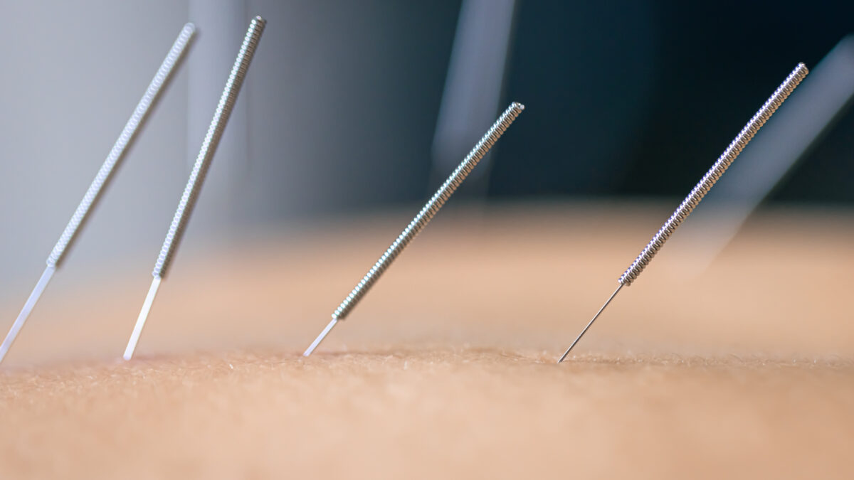 DN-behandling med tør nåle
