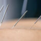 DN-behandling med tør nåle