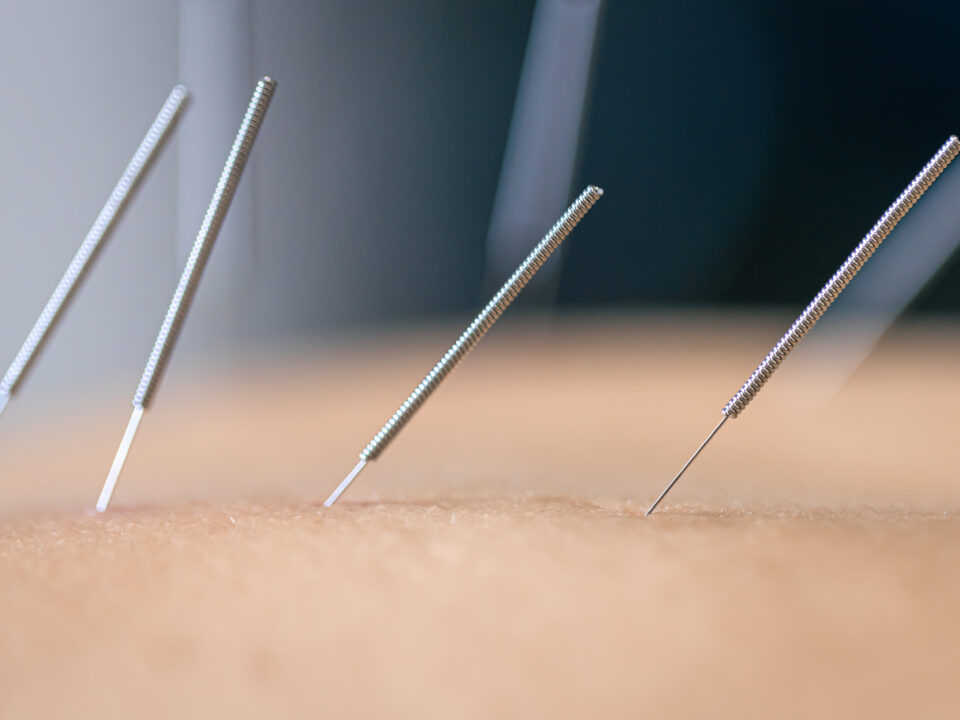 Dry needling DN therapy