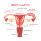 Hydrosalpinx Ultrasound