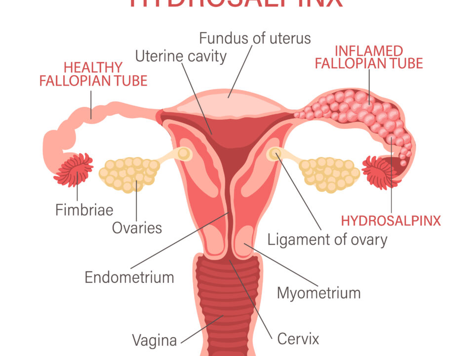 Hydrosalpinx Ultrasound