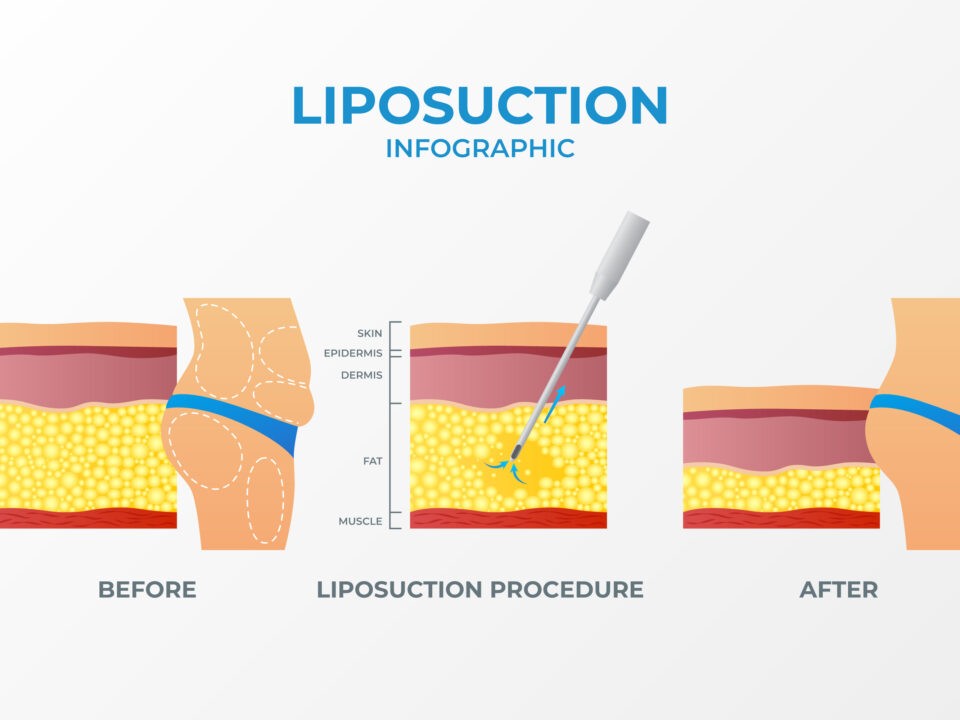Liposuction