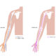 Lymphaticovenular anastomosis LVA