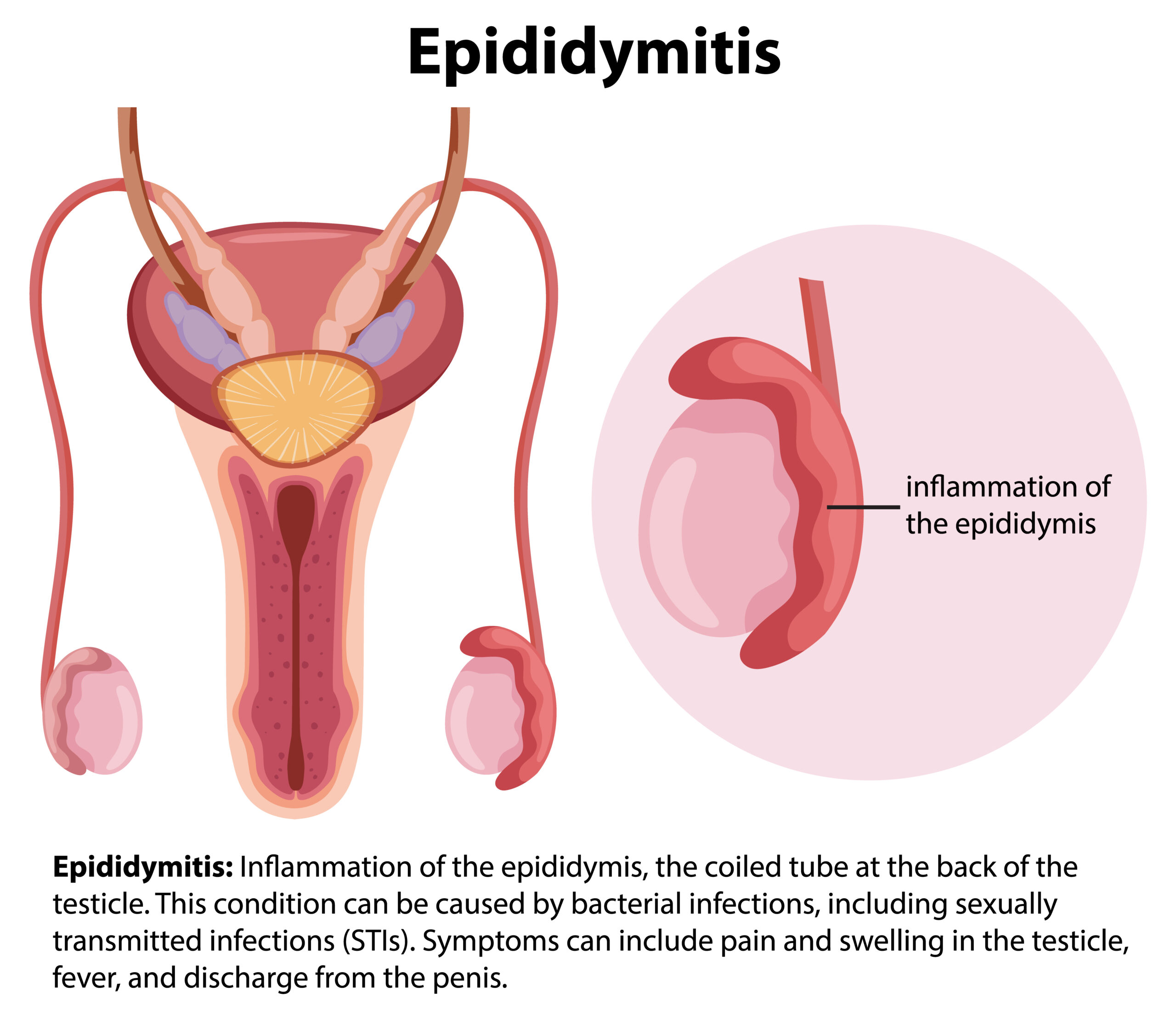 Scrotal Ultrasound