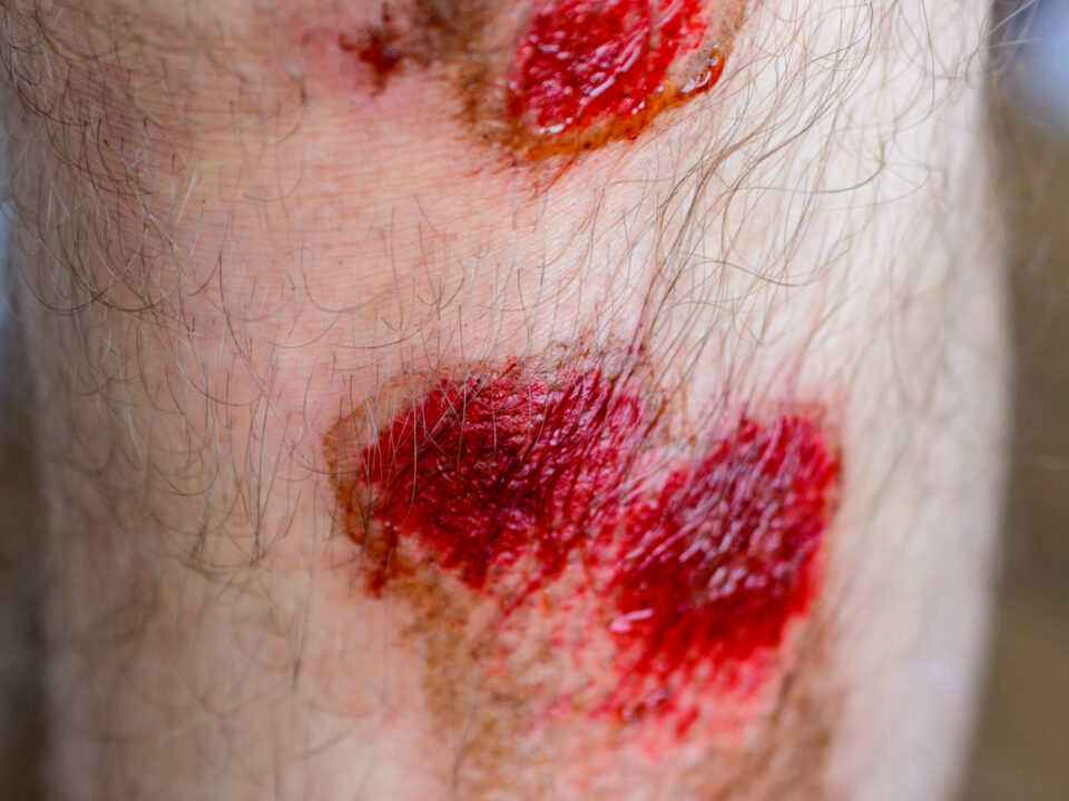 Seromas and Hematomas