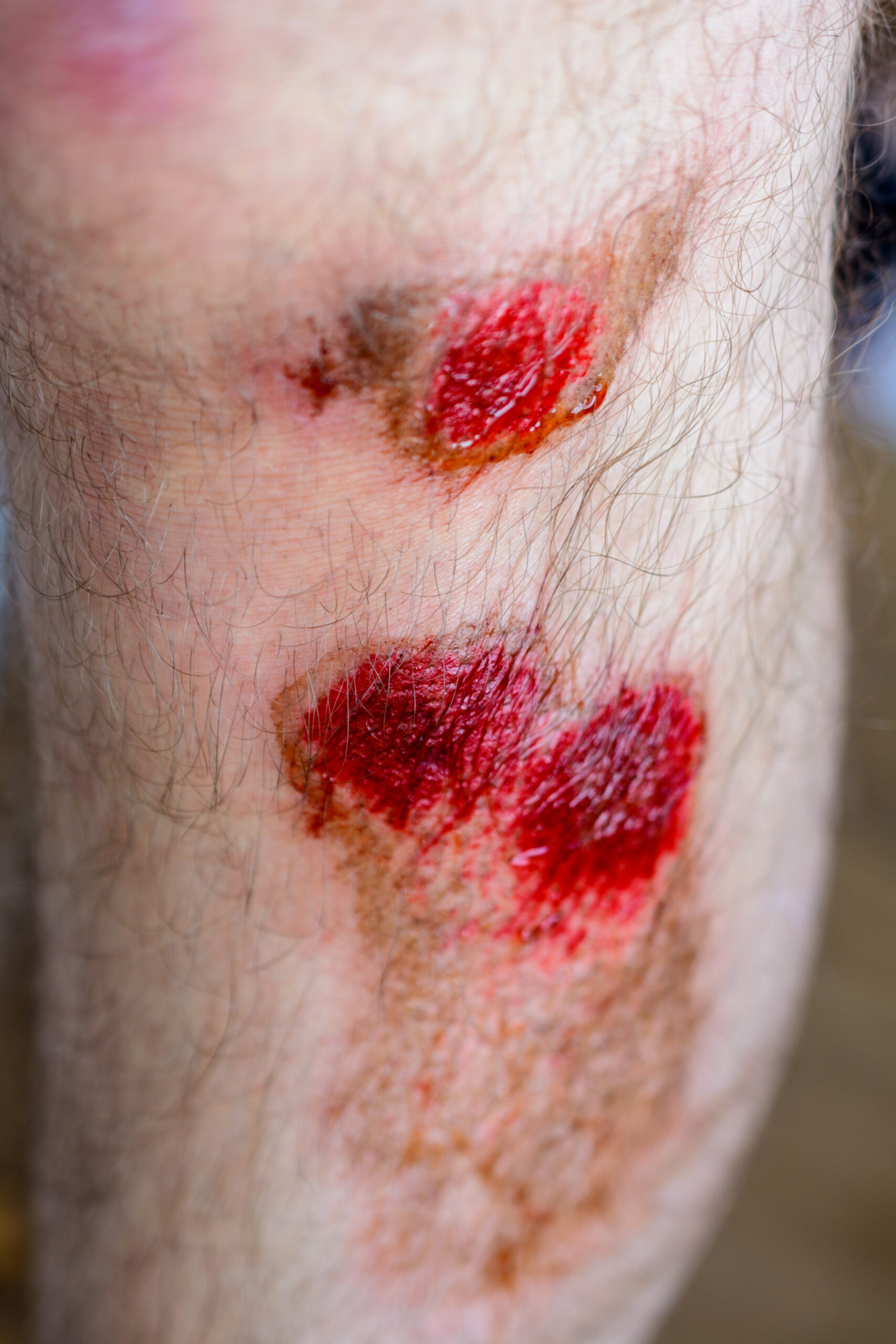 Seromas and Hematomas