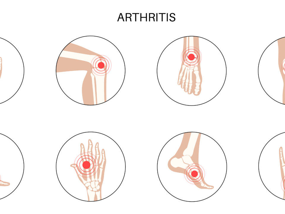Ultrasound-guided Arthrocentesis