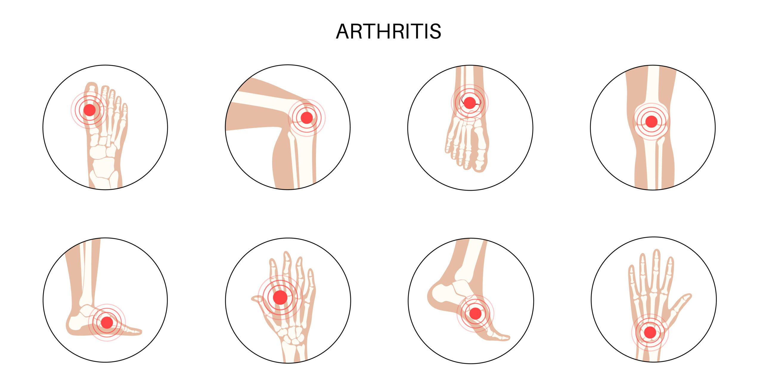 Ultrasound-guided Arthrocentesis