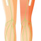 Ultraljudsledd lateral femoral kutan nerv